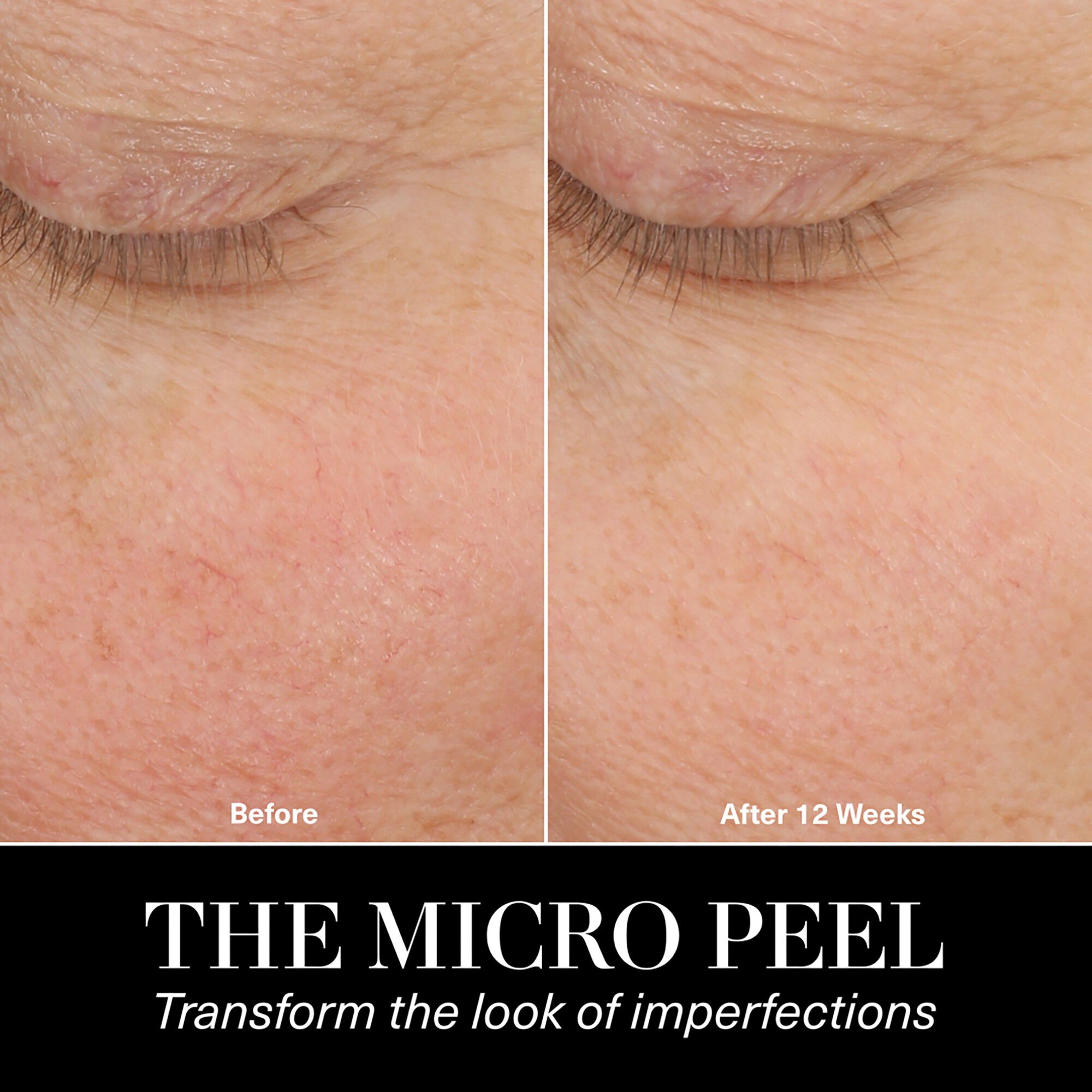 The Micro Peel Facial Peeling
