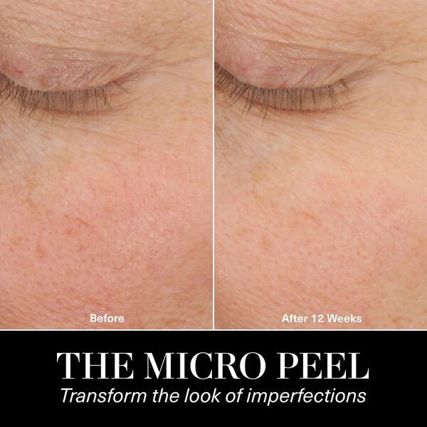 The Micro Peel Facial Peeling