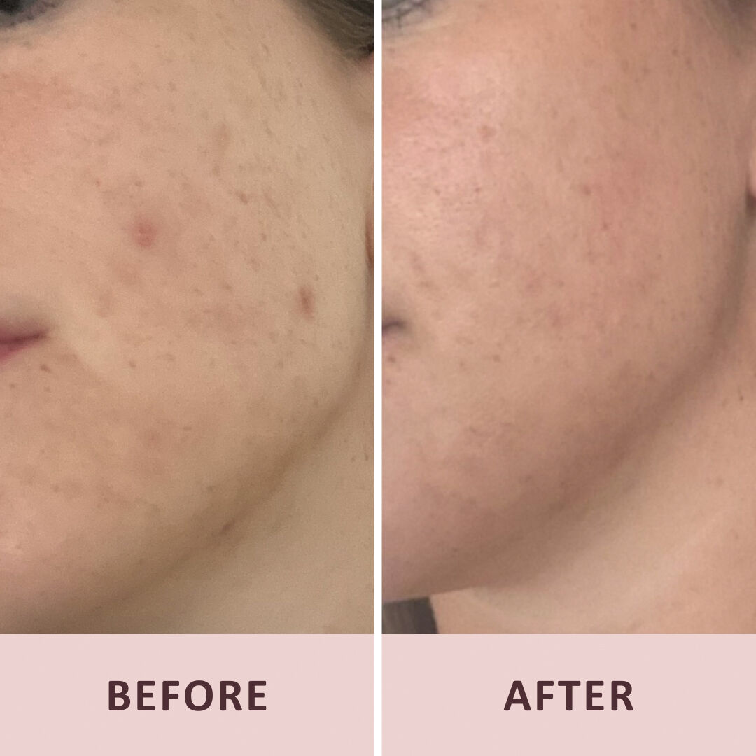 Pudderd&aring;serne Azelainsyre 10%