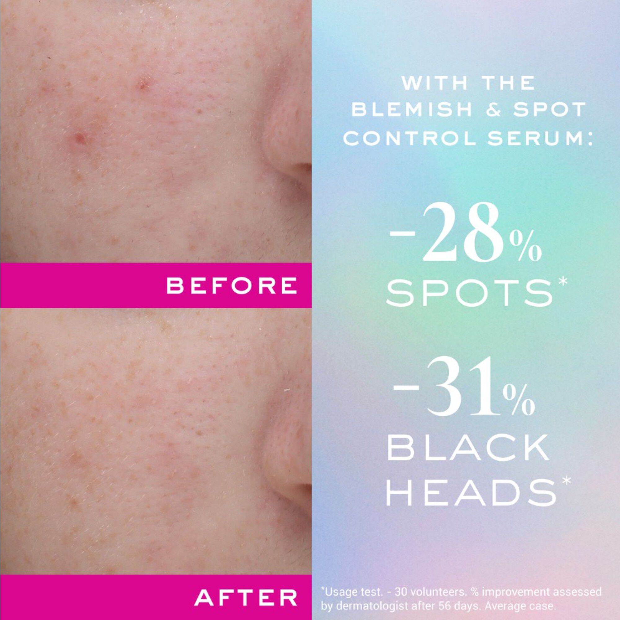 ZINC POWER BLEMISH AND SPOT CONTROL SERUM 30 ML