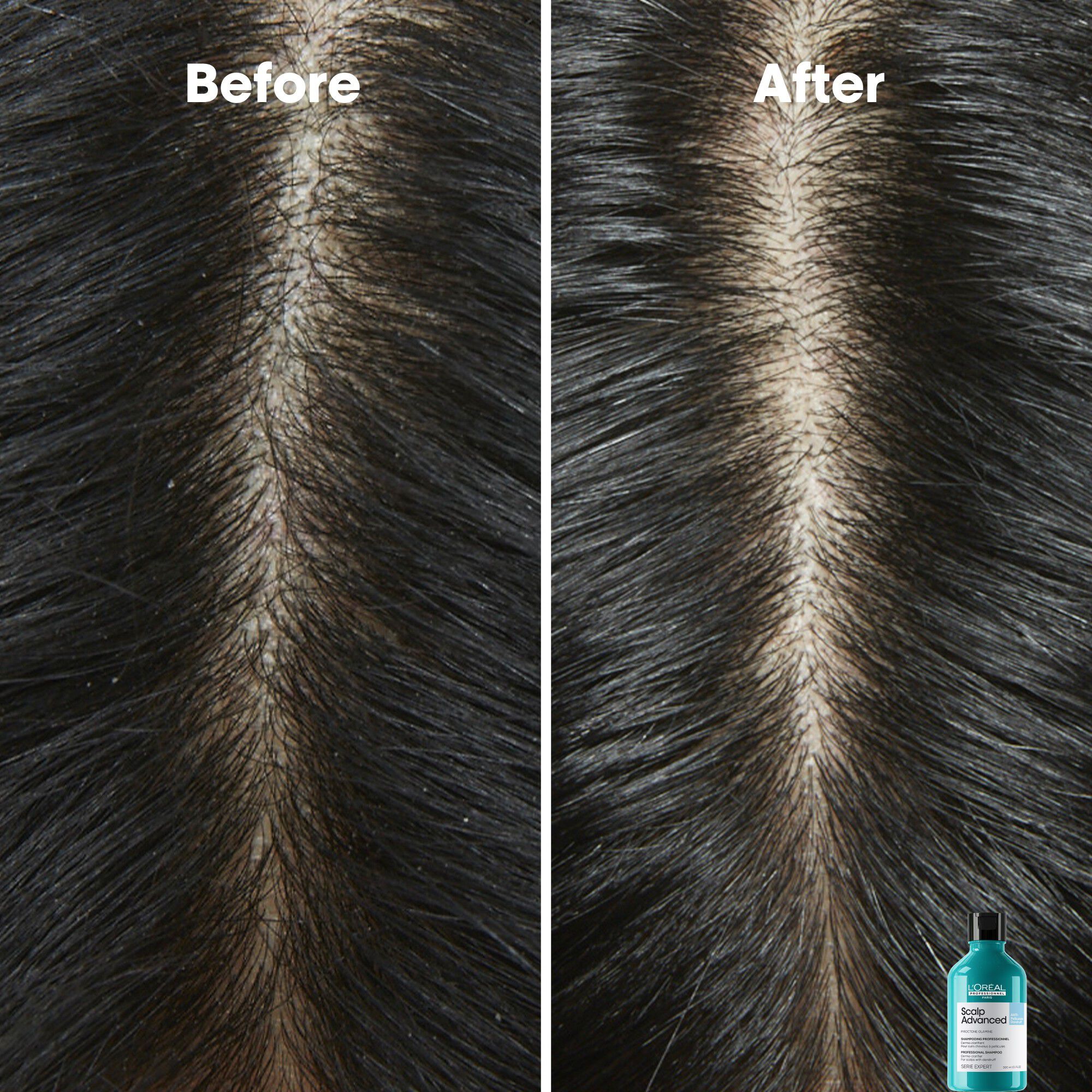 L'Or&eacute;al Professionnel Scalp Advanced Anti-Dandruff Shampoo 300ml