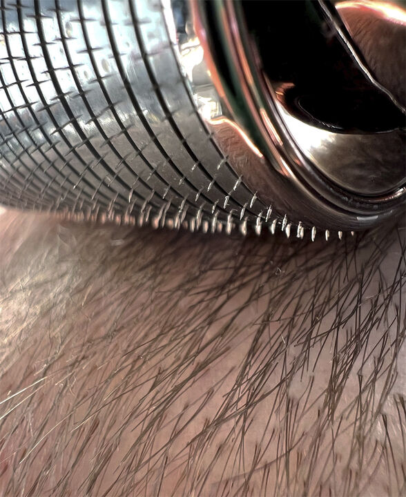 The Moonroller - Stimulerende mikronåle mod hårtab