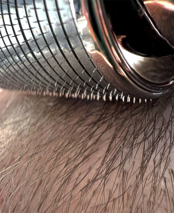 The Moonroller - Stimulerende mikronåle mod hårtab